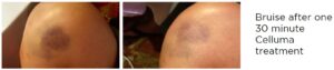 Red Light Therapy Bruise