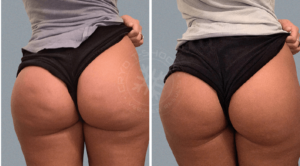 cellulite butt