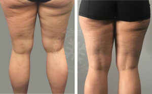 Cellulite Cryo T Shock