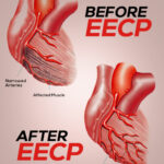 EECP Before and After