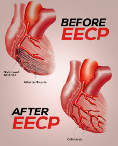 EECP Before and After