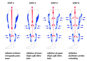 EECP Heart Blood Flow