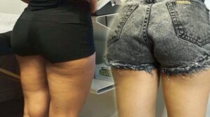 Before and After of cellulite removal