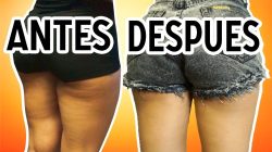 tratamiento celulitis antes y de