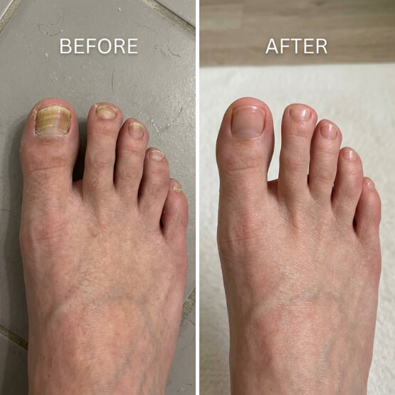 Fungabeam Pen Before and after