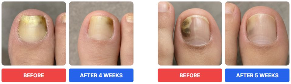Foliaya Fungus Pen Before & After