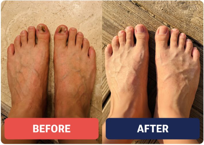 OnyGuard Nail Fungus Pen Before & After